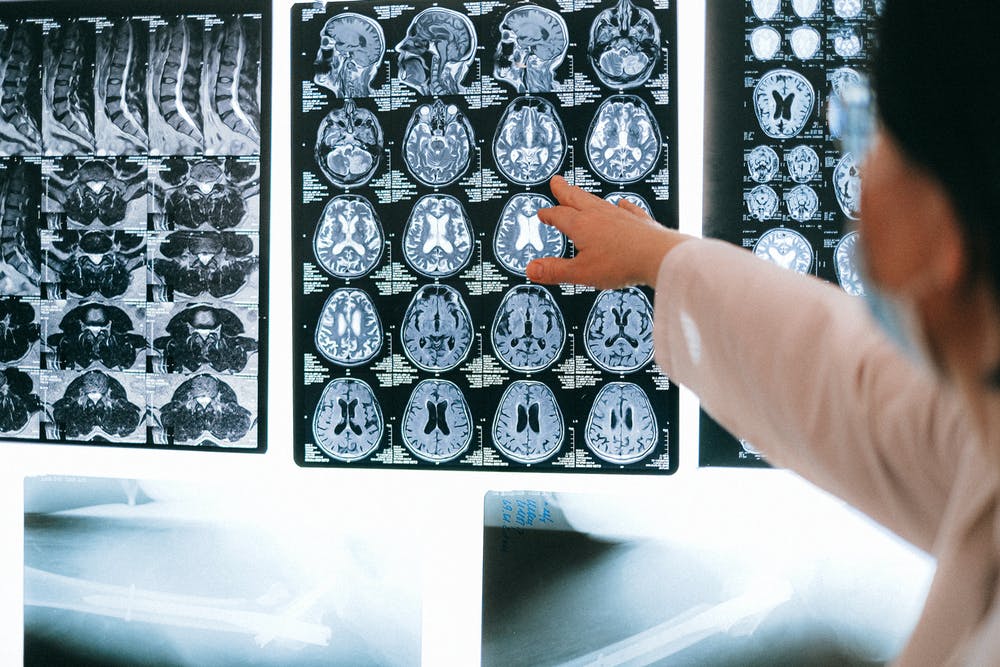 Imperial College Researchers Discover That CBD Blocks Pain Pathways